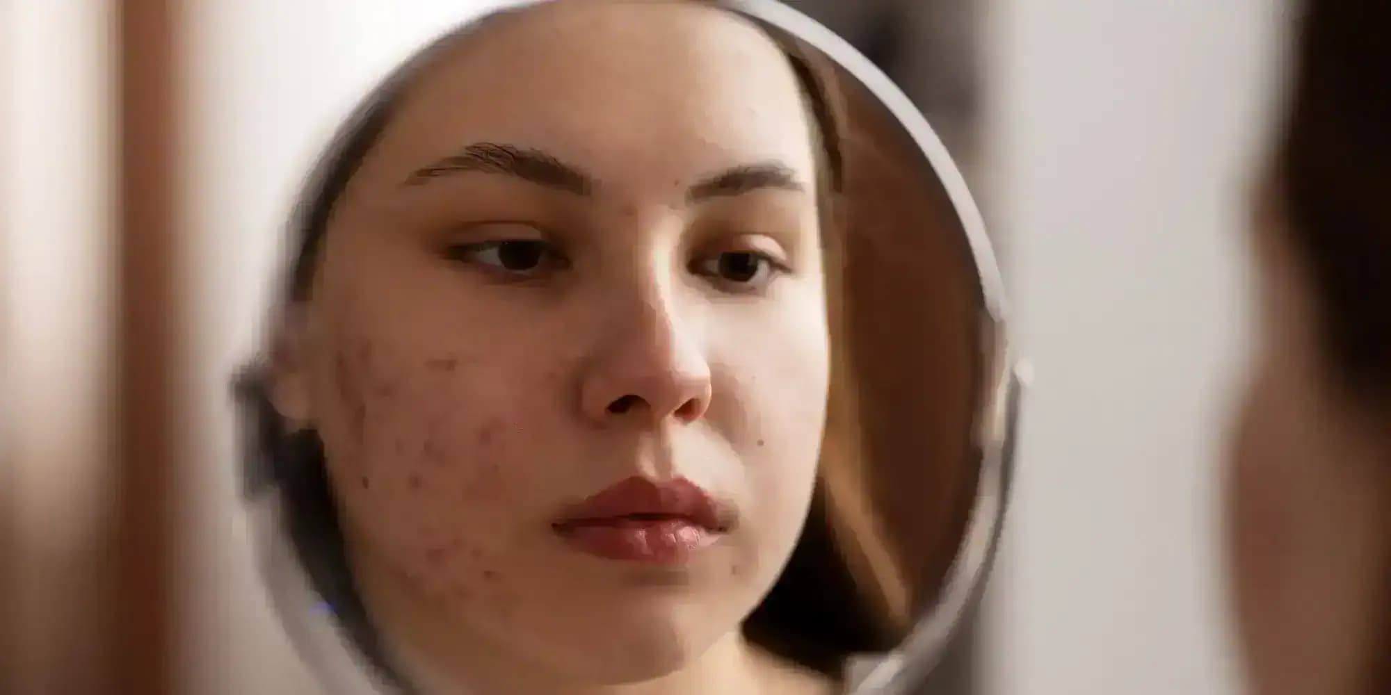 vitaminok pattanásos bőrre