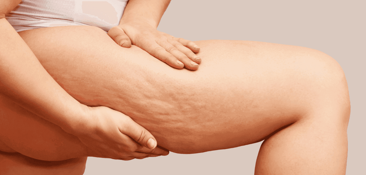 legjobb cellulitisz elleni krémek - comb